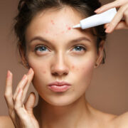 Natural Remedies for Acne-Prone Skin