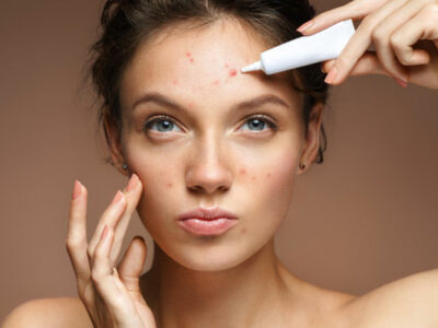 Natural Remedies for Acne-Prone Skin