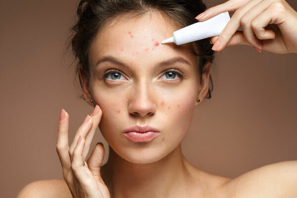 Natural Remedies for Acne-Prone Skin